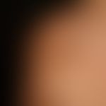 Differenzialdiagnose: Naevus melanozytärer kongenitaler

Diagnose: Becker-Naevus:&nbsp; Während d...