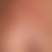 Calcinosis metastatica: Symmetrische, stelenweise linear angeordnete, mäßig schmerzhafte, harte, ...