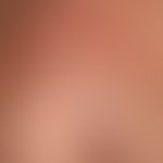 Calcinosis metastatica: Symmetrische, stelenweise linear angeordnete, mäßig schmerzhafte, harte, ...