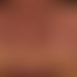 Systemic lupus erythematosus: flat, localized, moderately sharply defined, symmetrical, moderatel...