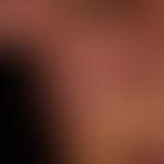 Systemic lupus erythematosus: flat, localized, moderately sharply defined, symmetrical, moderatel...