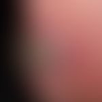 Impetigo contagiosa, großblasige (bullous impetigo):&nbsp; seit einigen Wochen sich entwicklende,...