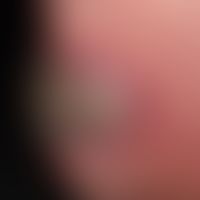 Impetigo contagiosa, großblasige (bullous impetigo):&nbsp; seit einigen Wochen sich entwicklende,...