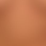 Urticaria pigmentosa: general view: about 0.5-1.0cm large, disseminated, oval or round, brownish-...