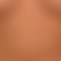 Urticaria pigmentosa: general view: about 0.5-1.0cm large, disseminated, oval or round, brownish-...
