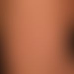 Urticaria pigmentosa: about 0.5-1.0cm in size, disseminated, oval or round, brownish-red spots. o...