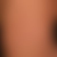Urticaria pigmentosa: about 0.5-1.0cm in size, disseminated, oval or round, brownish-red spots. o...
