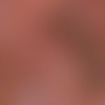 Lentigo of the mucosa: harmless lentigo of the labia minora, persisting unchanged for several yea...