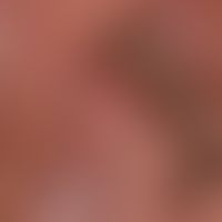 Lentigo of the mucous membrane: harmless lentigo of the left labia minora, persisting unchanged f...