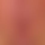 Lentigo of the mucosa: harmless lentigo ofthe mucosa which has persisted unchanged for a few year...
