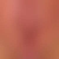 Lentigo of the mucosa: harmless lentigo ofthe mucosa which has persisted unchanged for a few year...