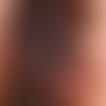 Melanom superfiziell spreitendes: auflichtmikroskpisches Bild mit unregelmäßigem, randlich deutli...