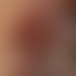 Melanom&nbsp; "Typ knotig umgewandeltes oberflächlich spreitendes&nbsp; Melanom": Detailaufnahme ...