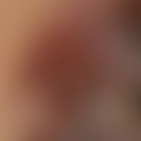 Melanoma "Type nodular transformed superficial spreading melanoma": detailed picture of an advanc...