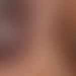 Melanom&nbsp; "Typ knotig umgewandeltes oberflächlich spreitendes&nbsp; Melanom": Detailaufnahme ...