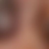 melanoma"type nodular transformed superficial spreading melanoma" : detailed view of the left bor...