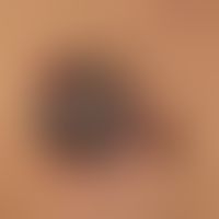 Melanoma "type nodular transformed superficial spreading melanoma": detailed view of an advanced ...