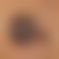 Melanoma "type nodular transformed superficial spreading melanoma": detailed picture of an advanc...