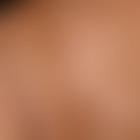 Lichen sclerosus extragenitaler (and genital): Generalized, itchy Lichen sclerosus with small and...