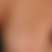 Lichen sclerosus extragenitaler (and genital): generalized, itchy Lichen sclerosus with small and...
