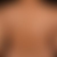 Lichen sclerosus extragenitaler (and genital): generalized, itchy Lichen sclerosus with small and...