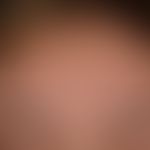 Lichtermatose polymorphe (akneiform): Auftreten der klinischen Symptomatik wenige Stunden bis Tag...