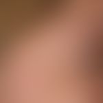 Lichtermatose polymorphe (akneiform): Auftreten der klinischen Symptomatik wenige Stunden bis Tag...