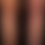 Reticulosis, pagetoid (disseminated type Ketron and Goodman): For several years slowly migrating,...