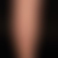 Reticulosis, pagetoid (disseminated type Ketron and Goodman): For several years slowly migrating,...