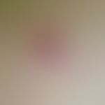 Varizellen: Detailausschnitt. Seit wenigen Tagen bestehendes vesikulöses Exanthem. Hier dargestel...