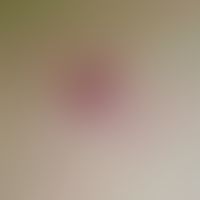 Varizellen: Detailausschnitt. Seit wenigen Tagen bestehendes vesikulöses Exanthem. Hier dargestel...