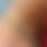 Pseudoxanthoma elasticum: Totally asymptomatic, reticular, yellowish papules and plaques on the e...