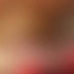 Pseudoxanthoma elasticum: Unusual infestation of the lip mucosa with symptomless, yellowish-white...