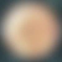 Pseudoxanthoma elasticum: Dermatoscopic picture of the right neck with translucent, yellowish-whi...