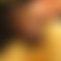 Frühsyühilis: 29jähriger Mann, MSM, Herkunftsland Singapur. Januar Oral- und Analverkehr in einem...