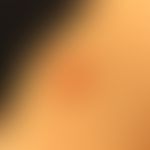 Seit Jahren bestehender asymptomatischer Knoten am Bauch einer 65jährigen Frau. Es erfolgte die E...