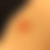 Seit Jahren bestehender asymptomatischer Knoten am Bauch einer 65jährigen Frau. Es erfolgte die E...