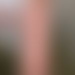 Livedo reticularis: Oberschenkel einer 24-Jährigen nach Saunabesuch mit kaltem Abduschen. Nebenbe...