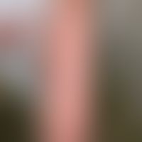 Livedo reticularis: Oberschenkel einer 24-Jährigen nach Saunabesuch mit kaltem Abduschen. Nebenbe...