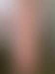 Livedo reticularis: Oberschenkel einer 24-Jährigen nach Saunabesuch mit kaltem Abduschen. Nebenbe...