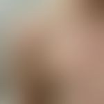 Livedo reticularis: rechte Schulter einer 24-Jährigen nach Saunabesuch mit kaltem Abduschen. Die ...