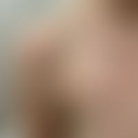 Livedo reticularis: rechte Schulter einer 24-Jährigen nach Saunabesuch mit kaltem Abduschen. Die ...