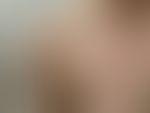 Livedo reticularis: rechte Schulter einer 24-Jährigen nach Saunabesuch mit kaltem Abduschen. Die ...