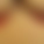 Psoriasis inversa: 69jährige Frau. Bestandsdauer bei Vorstellung 6 Monate. Am restlichen Integume...