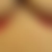 Psoriasis inversa: 69-year-old woman. 6 months at presentation. no manifestations of psoriasis pr...