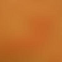 Pityriasis rosea: Collerette-Schuppung: Für die Pityriasis rosea pathognomonische Form der Schupp...