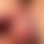 Herpes simplex virus infection: Typical clinical finding of genital herpes simplex. 2 grouped ves...