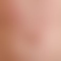 Caterpillar dermatitis: A few hours after "stand-up paddling" itching and burning dermatitis with...