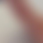 Dermatitis medusica: Wenige Minuten nach dem Kontakt-Ereignis, Darstellung&nbsp; linearen, stark ...