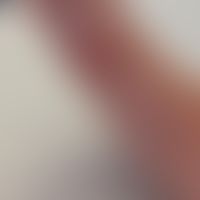 Dermatitis medusica: Wenige Minuten nach dem Kontakt-Ereignis, Darstellung&nbsp; linearen, stark ...